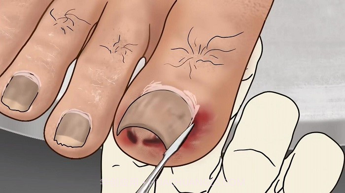 修脚足疔模拟器测试版截图1 修脚足疔模拟器测试版截图1